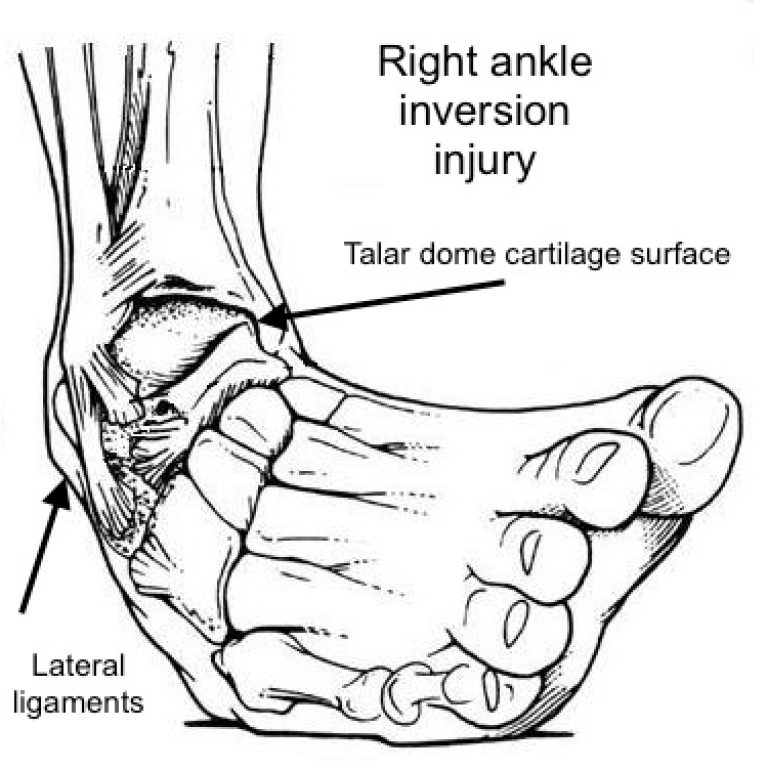 Melbourne Eastern Healthcare Ankle Instability