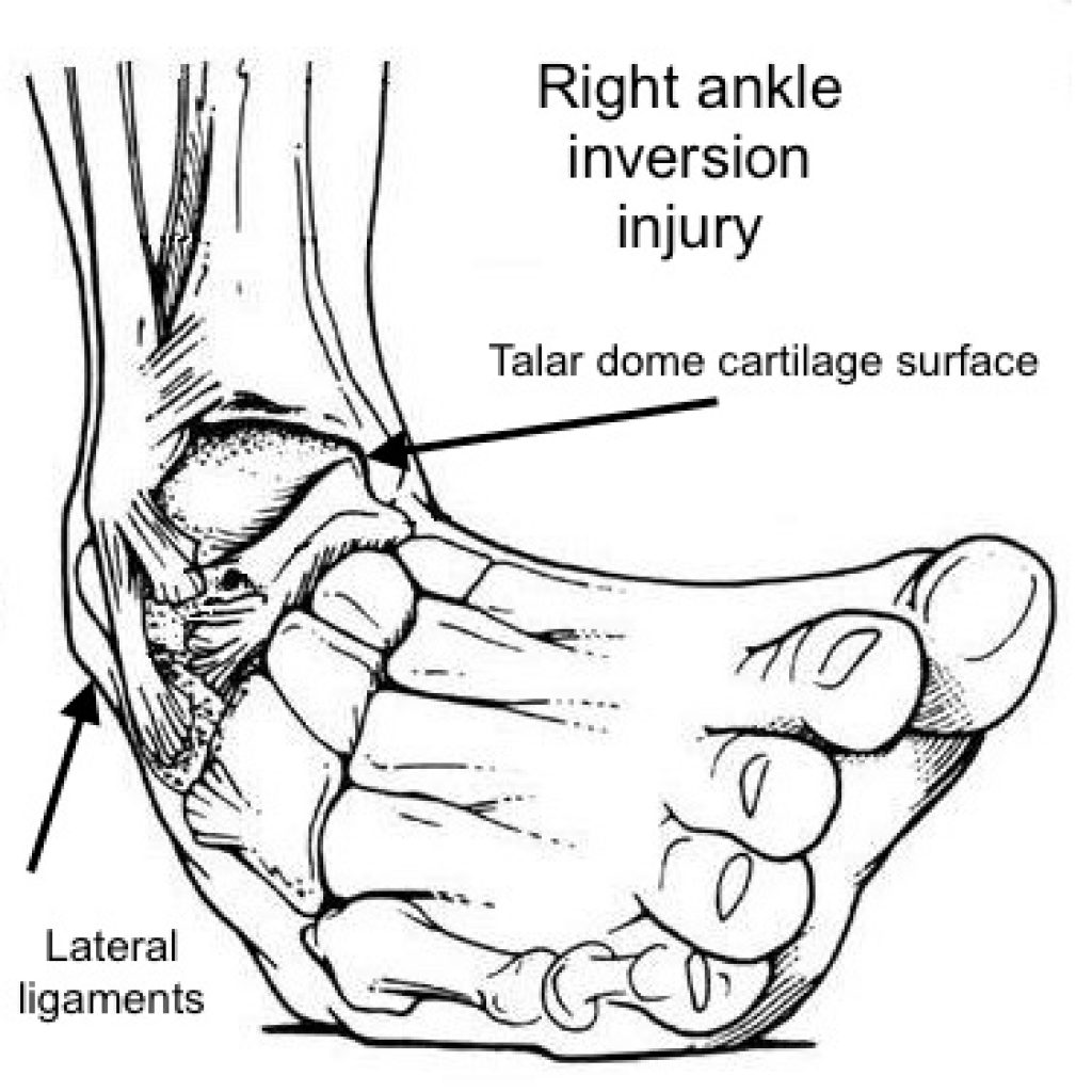 Melbourne Eastern Healthcare: Ankle Instability